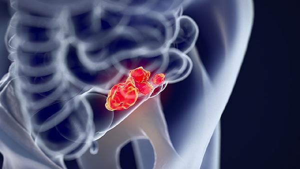 舌下腺囊肿的症状有哪些?(图2)