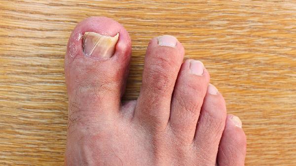 脚指甲有黑点是怎么回事?(图3)