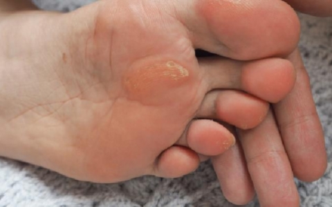 女性感染尖锐湿疣的危害有哪些 女性需知尖锐湿疣的三个危害