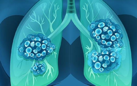 输尿管肿瘤治疗：手术并非唯一选择，如何量身定制你的健康方案？