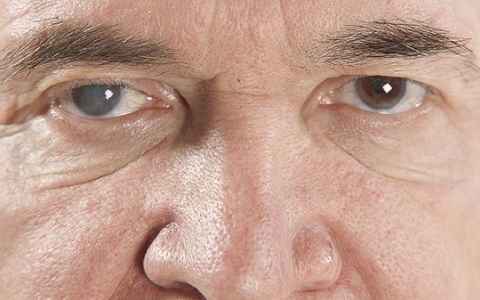 有时候眼睛突然刺痛流眼泪