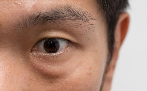 早睡可以改善眼袋吗