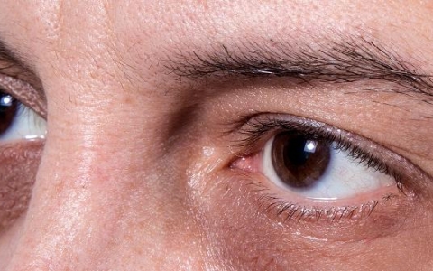 怎样区分睑裂斑与翼状胬肉