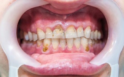 牙龈旁边肿了是怎么回事