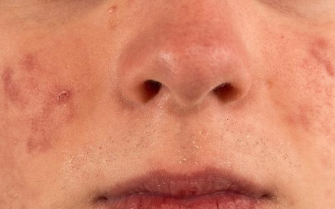 酒渣鼻是否真的会遗传呢