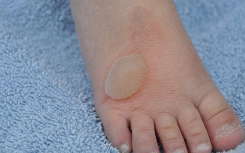 脚上水泡瘙痒？揭秘3大元凶与快速缓解妙招