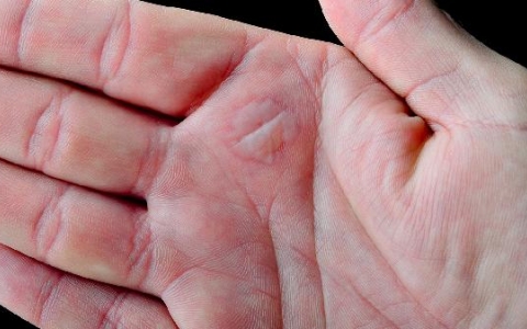 脚趾间水泡背后的真相：5大原因及有效预防方法揭秘！