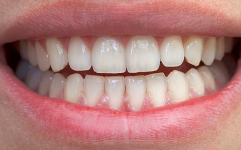 左下角植牙应该植多少棵