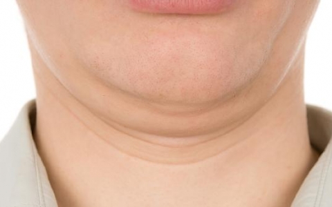 催吐下巴两侧鼓起来能消退吗