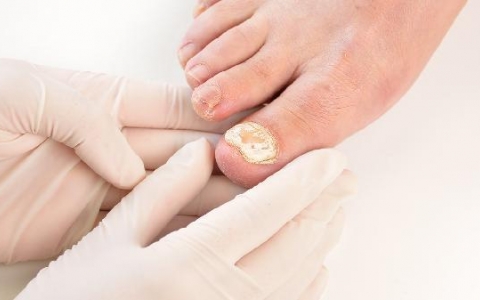 脚趾指甲盖不知道怎么了