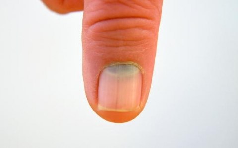 指甲前沿空心是什么原因