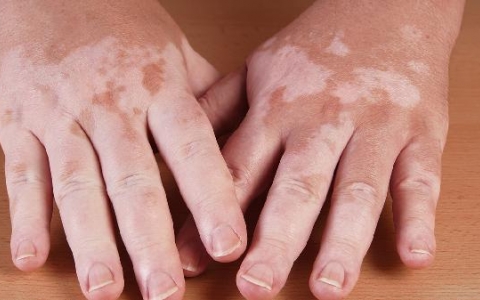 白斑病的危害要怎么预防