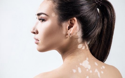 身上有白斑可以吃冷饮吗