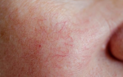 发红发热型红血丝怎么恢复