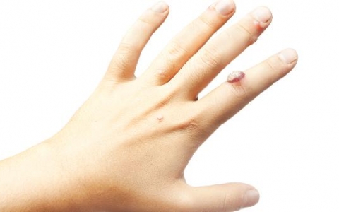 湿疣治疗后复发是什么样