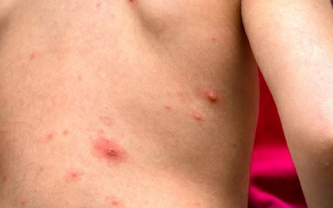 身上有铜币一样的红圈