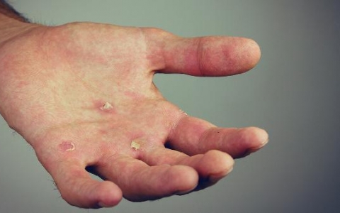 起针尖大小的小水泡是什么原因