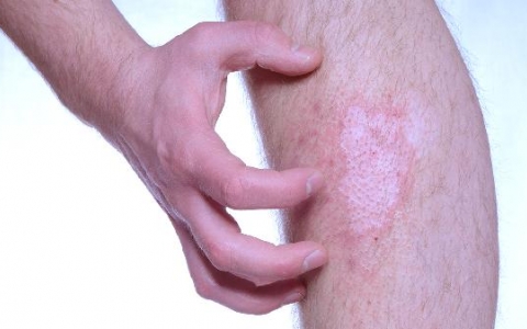 如何去除手上的茧