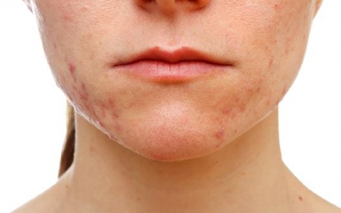 下巴发黑是什么原因