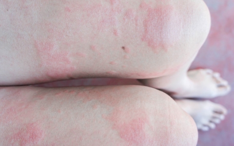 生殖器疱疹的危害有这几种 生殖器疱疹带来哪些严重危害