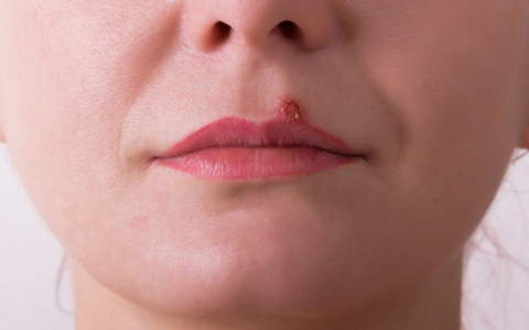 2个导致生殖器疱疹的原因 引起生殖器疱疹的原因是哪些