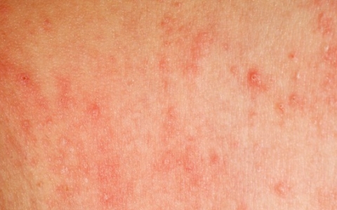 女性梅毒真实照片 得了梅毒的症状