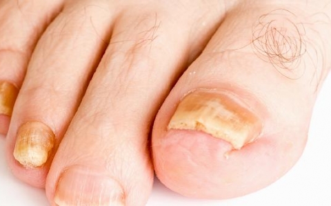 指腹发白是怎么回事