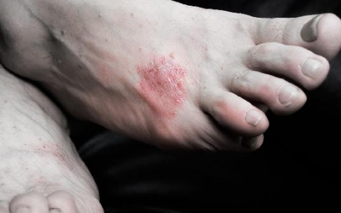 银血病怎么治疗