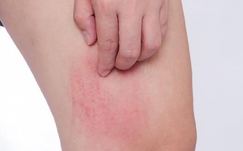 屁股以及胳膊上起了一些东西