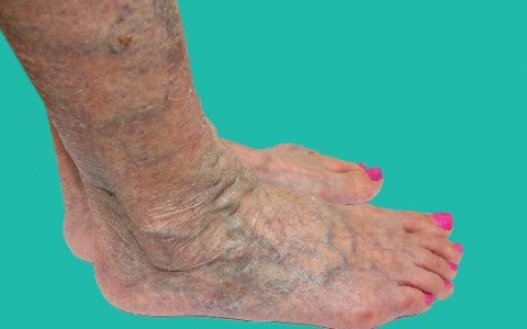 足底疣的治疗方法有哪些？