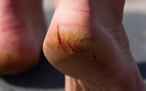 手背皲裂什么原因怎么办