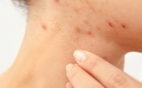 揭开生殖器疱疹的秘密：如何识别症状并有效治疗？