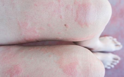 疱疹怎么治疗 治疗疱疹的食疗方法