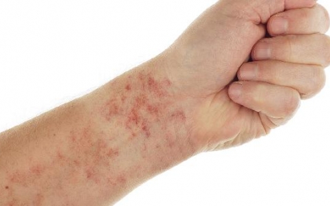 红色丘疹是如何引起的