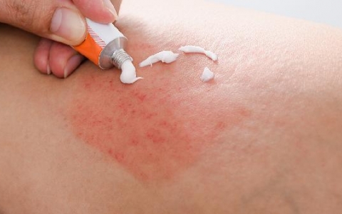 疱疹是什么 对于疱疹的介绍