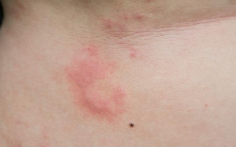 身上出现红色丘疹发痒是什么原因