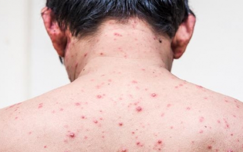 疱疹不能吃的六种东西