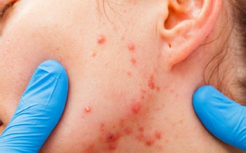 结节型痘痘怎么消下去