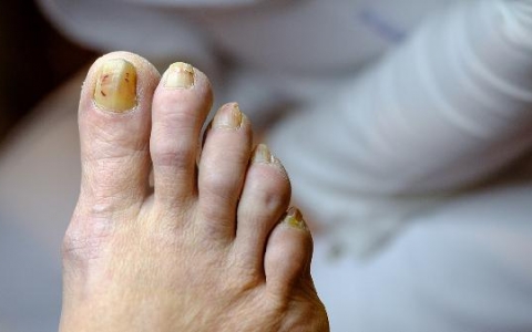 呆小症是什么激素分泌不足