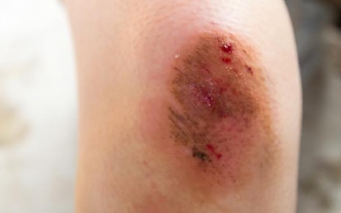 女童右胸肿胀手触有小硬核是不是早发育