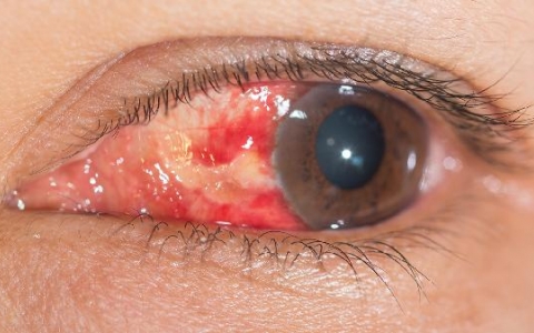 诺氟沙星为何18岁以下禁用