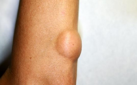 胸锁乳突肌一边凸起是什么原因