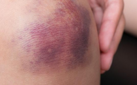 深度解读：髂窝脓肿的病因和治疗