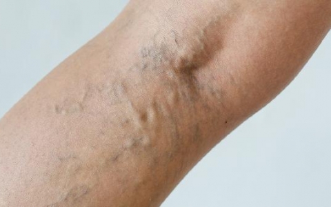 手臂上疑似被虫咬了？两三天了还是红肿的