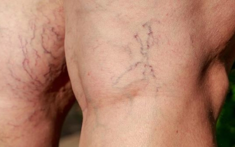 甲状腺会引起小腿浮肿吗
