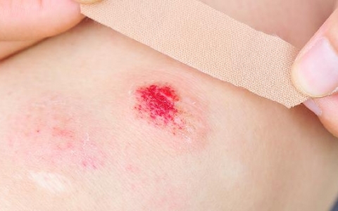 伤口里的脓不挤出来会影响愈合吗