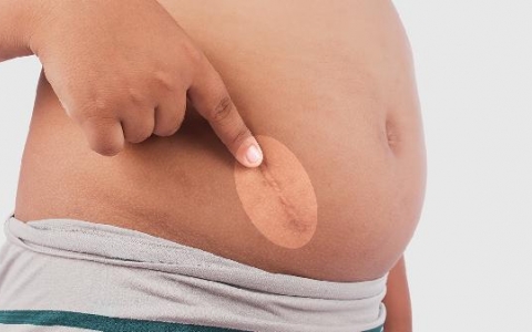 伤口结痂裂开露肉怎么办