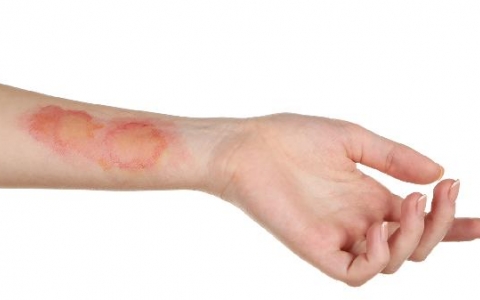 伤口包扎和暴露哪个愈合快