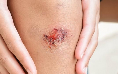 伤口结痂又裂开露肉怎么回事怎么办