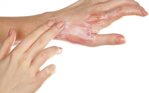 伤口化脓如何处理